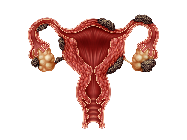 Phenotypes of Endometriosis: Understanding the Different Forms